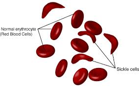 sickle and red blood cells